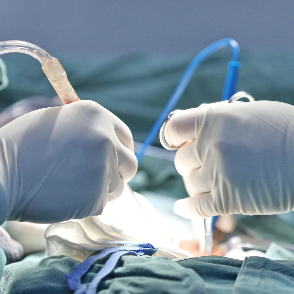Bimba di 6 mesi salvata con trapianto di fegato della mamma e autotrapianto di vena giugulare a Torino